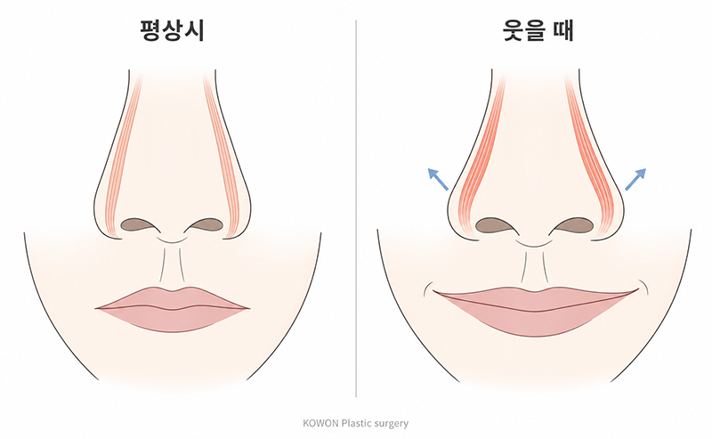웃을 때 콧볼 퍼짐 — 상순비익거근의 작용과 콧볼 확장 비교