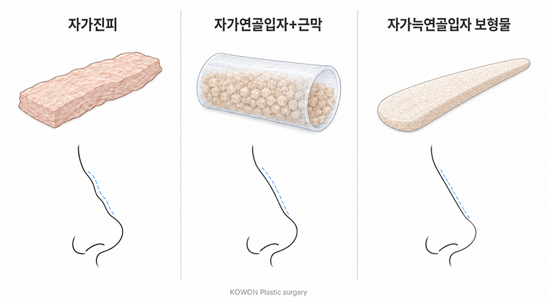 자가조직 콧대 비교 — 자가진피·자가연골입자·자가늑연골입자 보형물의 차이