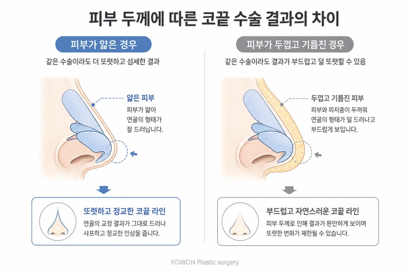 복코 수술 결과 차이 — 피부 두께에 따라 달라지는 코끝 슬림 정도