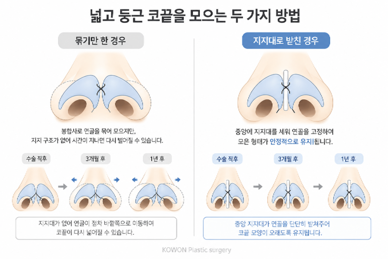 복코 코끝 교정 구조 — 연골을 모아 지지대로 받쳐 재퍼짐을 막는 방식