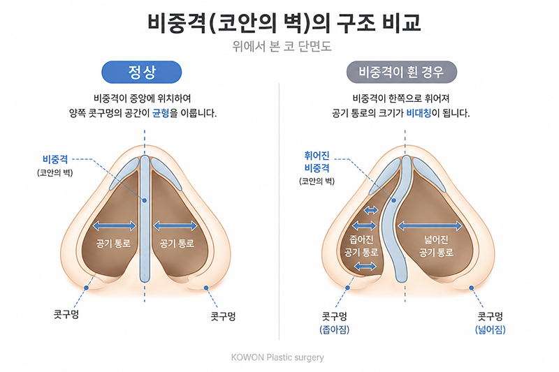 휜코와 비중격 — 안쪽 기둥이 휘면서 한쪽 콧구멍이 좁아지는 구조