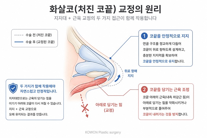 화살코 교정 구조 — 코끝 지지대와 처짐을 유발하는 근육을 함께 다루는 방식