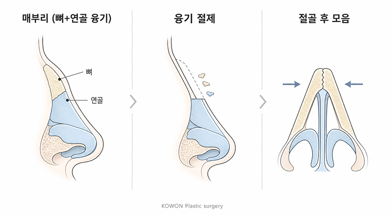 매부리코 교정 — 콧대 굴곡과 코끝 비율을 함께 맞추는 라인 비교