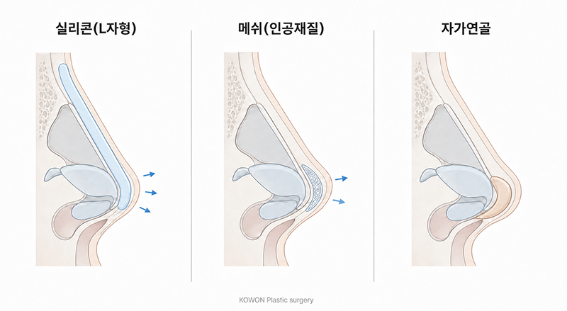 코끝 재료 비교 — 인공 보형물과 자가연골 지지대의 차이