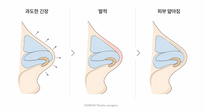 코끝 피부 얇아짐 진행 단계 — 발적에서 보형물 비침까지의 단면 구조