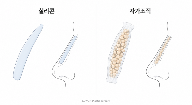 콧대 재료 비교 — 실리콘과 자가조직의 성질 차이