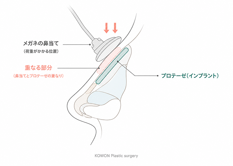メガネの鼻当てとプロテーゼの位置
