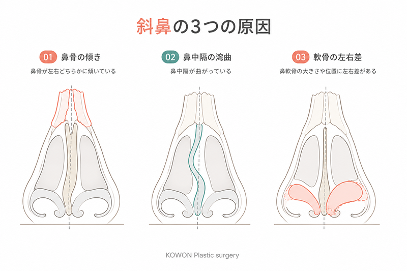斜鼻の3つの原因