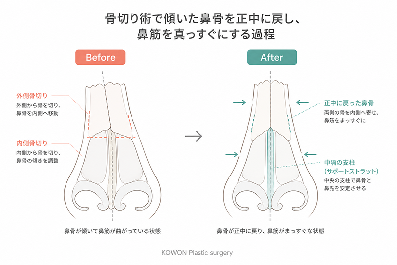 骨切り術と鼻中隔矯正のイメージ