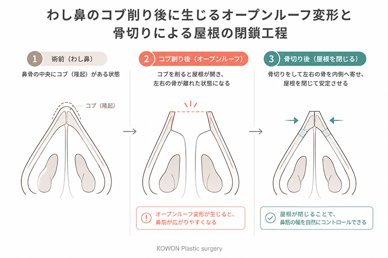 ハンプ切除後のオープンルーフ変形と骨切りの工程