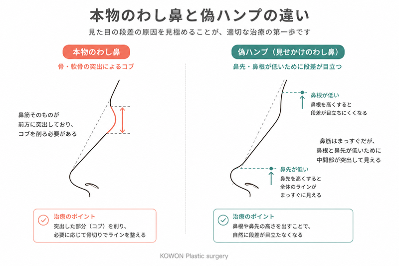 本物のわし鼻と偽ハンプの違い